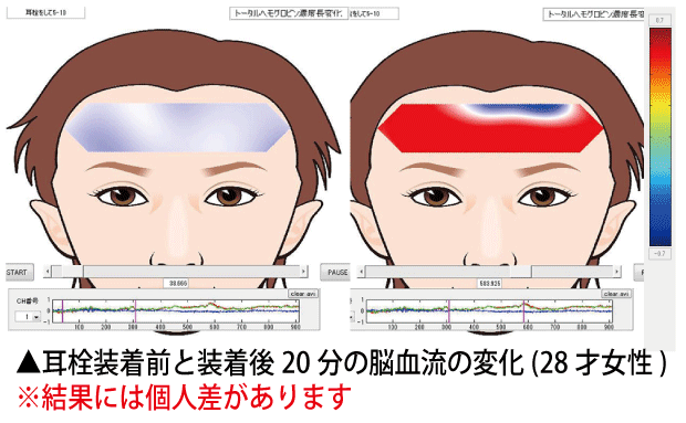 【お取り寄せ★納期 最長 約2週間】電磁波対策シリーズ スッキリ除電耳栓 ミミケア 耳鼻兼用★静電気除去！生体電流を高めて頭も視界も聴力もはっきり